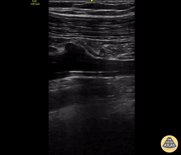 Vascular - PICC Line in Subclavian Vein