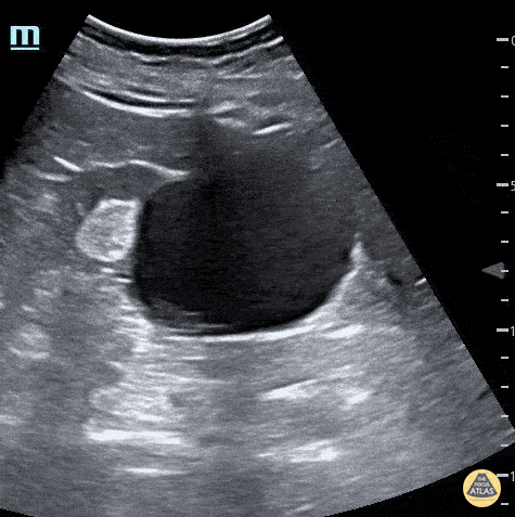 Renal/GU - Large Simple Renal Cyst