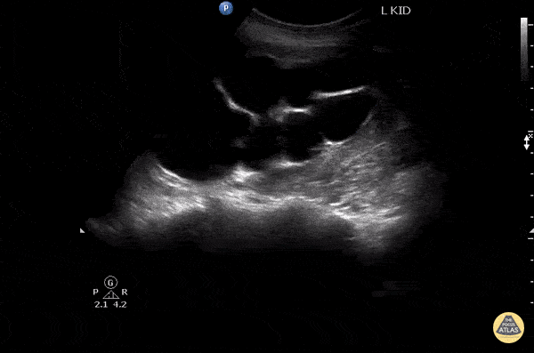 Renal/GU - Severe Hydronephrosis vs Cyst?