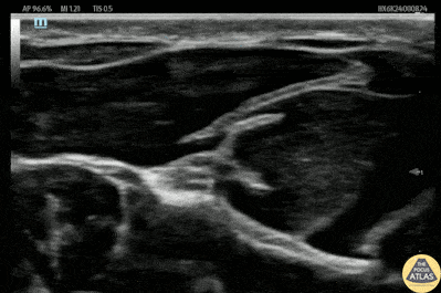 Nerve Block Gallery - Median Nerve Block for Laceration Repair