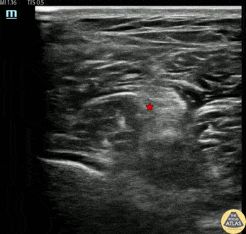 Nerve Block Gallery - Popliteal Sciatic Nerve Block for Foreign Body Removal