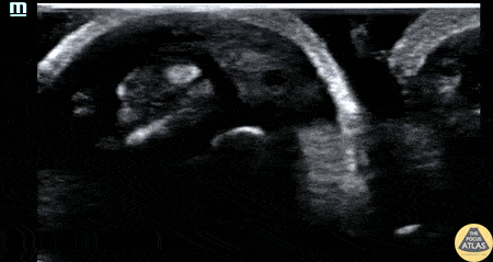 Musculoskeletal - Flexor Tenosynovitis