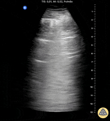 Pulmonary - Lung Point in Iatrogenic Pneumothorax