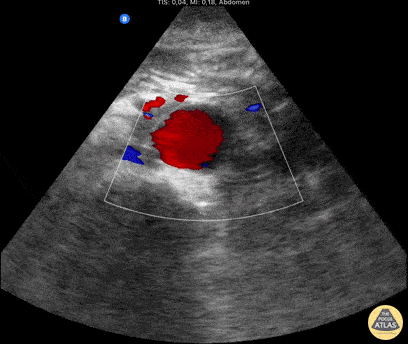 UPLOADS FOR REVIEW - Aneurysm of the Abdominal Aorta