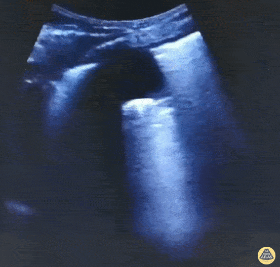 Pulmonary - Subpleural Consolidation in COVID-19