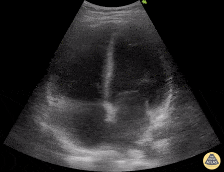 Left Ventricular Dysfunction - Post COVID Myocarditis