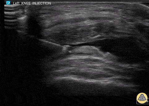 Musculoskeletal - Corticosteroid Joint injection in Suprapatellar Recess