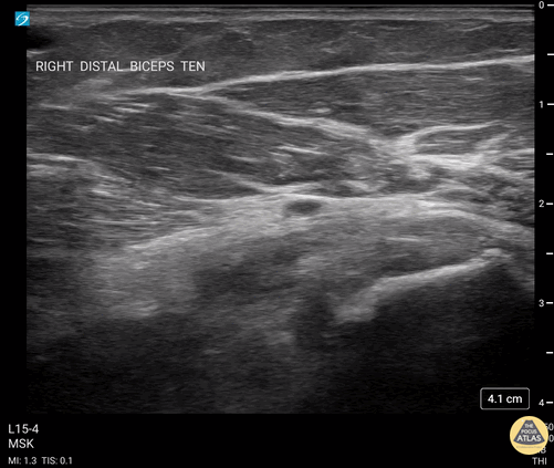 Musculoskeletal - Biceps Tendinosis