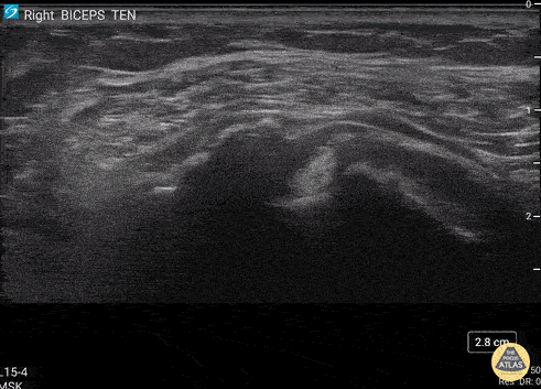Musculoskeletal - Biceps Tendon Sheath Effusion