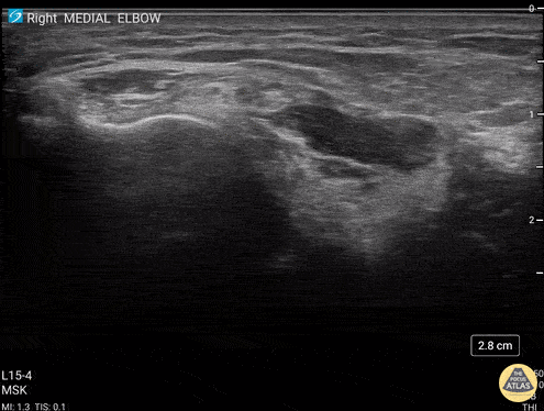Musculoskeletal - Common Flexor Tendon Tear At Elbow