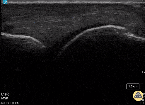 Musculoskeletal - Metacarpal Head Fracture