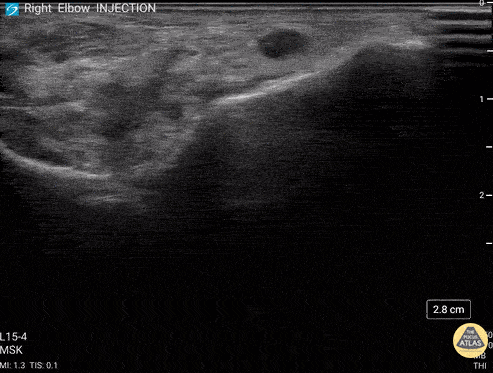 Musculoskeletal - Posterior Elbow Joint Injection