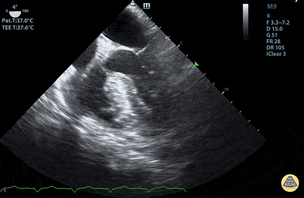 TEE - Mid-Esophageal 4 Chamber View  with a Trace Pleural Effusion