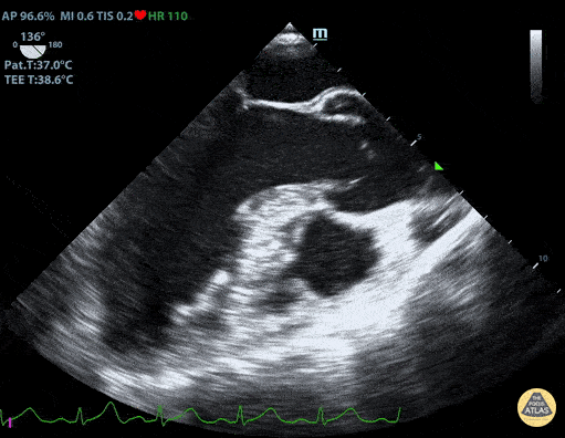 TEE - Normal Mid-Esophageal Long Axis View