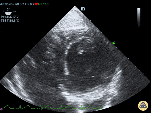 TEE - Normal Trans-Gastric Short Axis View