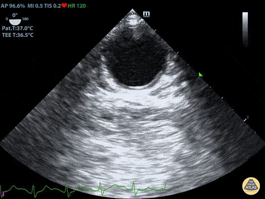 TEE - TEE Normal Aorta Short Axis