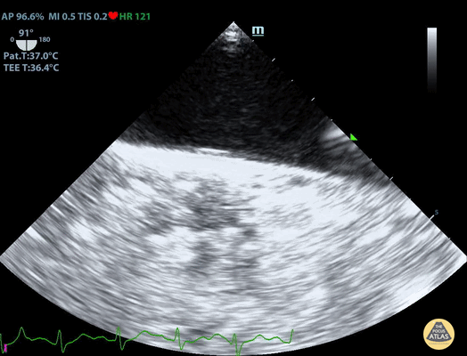 TEE - TEE Normal Aorta Long Axis