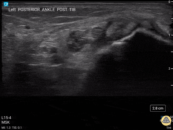 Musculoskeletal - Transverse view scanning Proximal to Distal at the Posteromedial Ankle