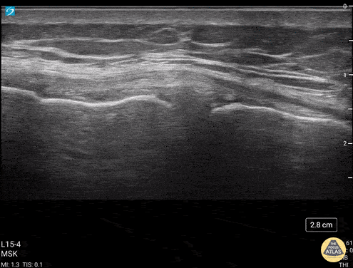 UPLOADS FOR REVIEW - Coronal view and long axis of the MCL at the medial knee