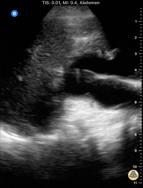 UPLOADS FOR REVIEW - Severe HUN Right Kidney