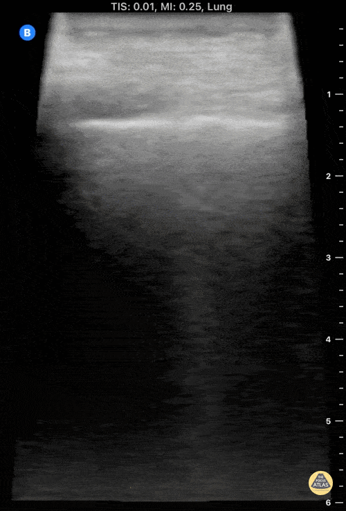 UPLOADS FOR REVIEW - Small sub-pleural consolidation in left lung base