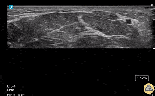 UPLOADS FOR REVIEW - bifid median nerve