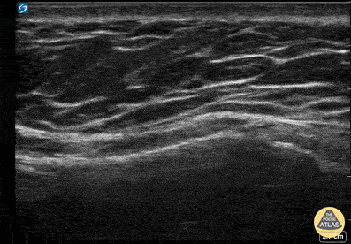 UPLOADS FOR REVIEW - Sternum Fracture