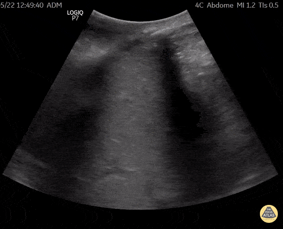 UPLOADS FOR REVIEW - Large Unilateral Right Hydronephrosis