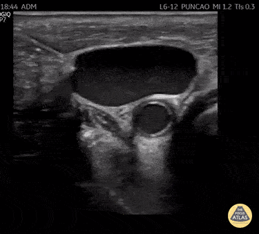 UPLOADS FOR REVIEW - IVJ Canulation POCUS