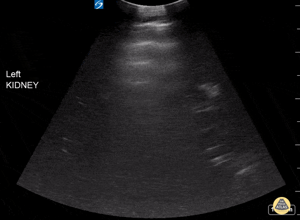 UPLOADS FOR REVIEW - Recessive Polycystic Kidney Disease