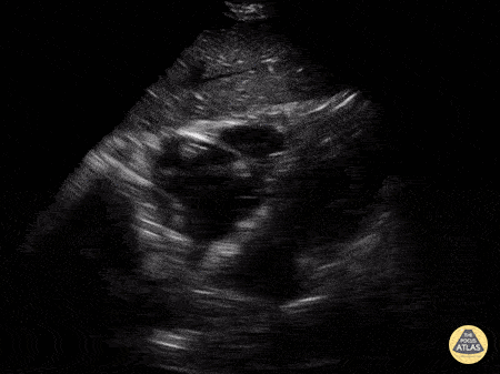 UPLOADS FOR REVIEW - Acute PE Clot in RA