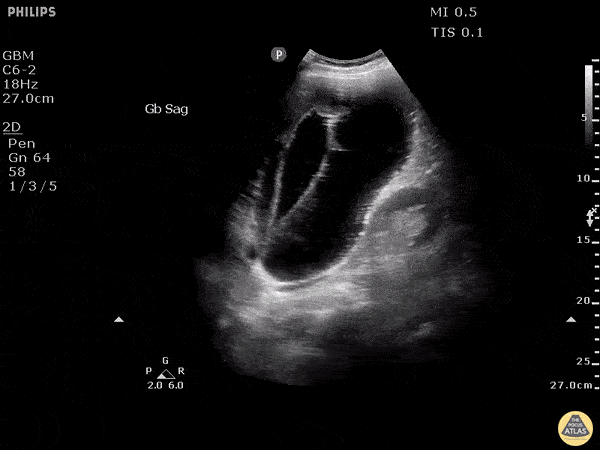 Biliary - Gangrenous Cholecystitis