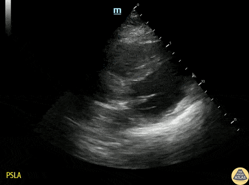 Left Ventricular Dysfunction - Regional Wall Motion Abnormality