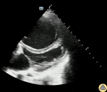 Right Ventricular Dysfunction - Pulmonary Hypertension from Triscupid Endocarditis