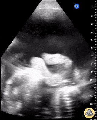 Bowel-GI - Malignant Ascites