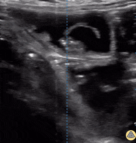 Bowel-GI - Taenia Saginata