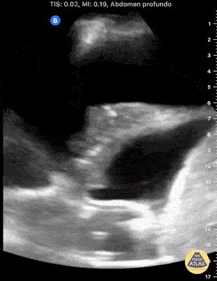 UPLOADS FOR REVIEW - Presence of Anechoic Space with Internal Echoes