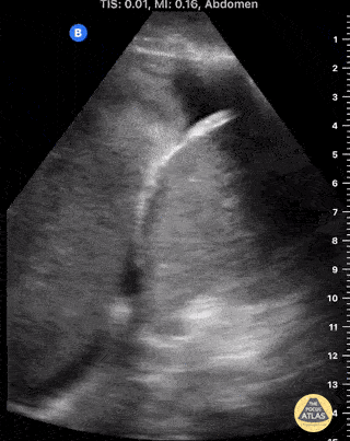 UPLOADS FOR REVIEW - Post-Op Hemothorax