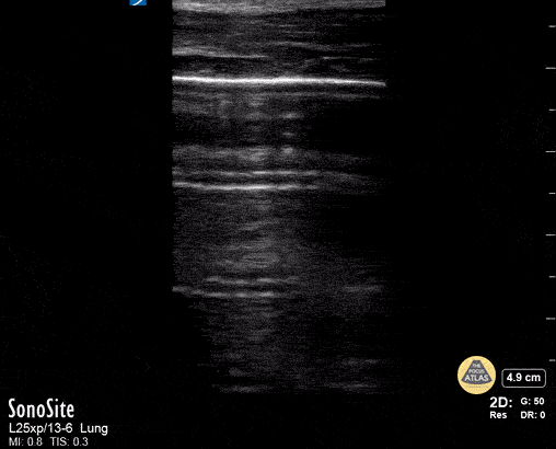 Peds-Lung - Normal Lung Slide
