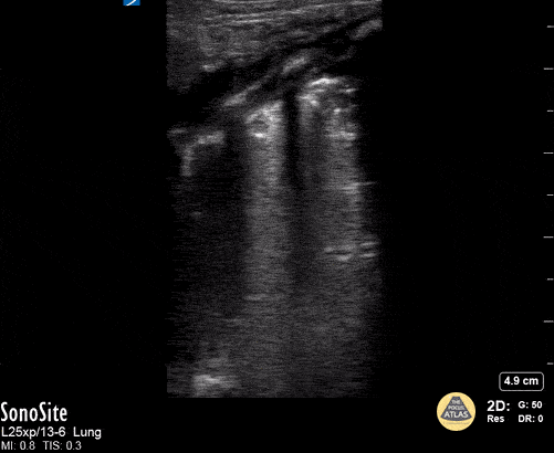 Peds-Lung - Confluence of B-Lines