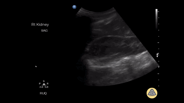 Renal/GU - Adrenal Metastasis