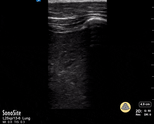 Peds-Lung - Lung Consolidation