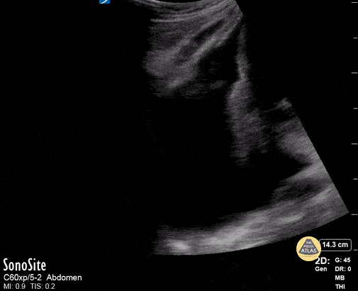 Peds-Lung - Large Pleural Effusion