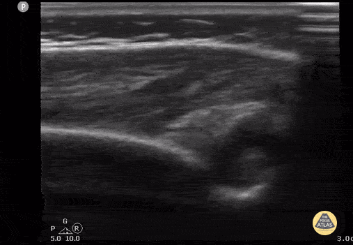 Peds-MSK - Septic Elbow Effusion