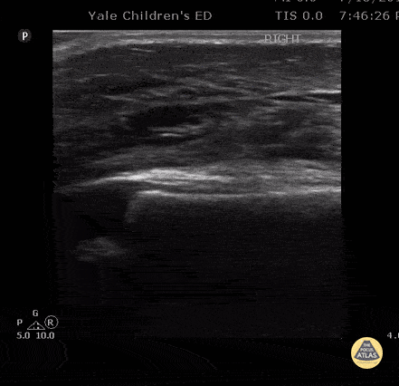 Peds-MSK - Soft Tissue Edema after Vaccination