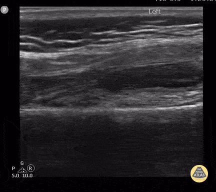 Peds-MSK - Septic Knee Arthritis
