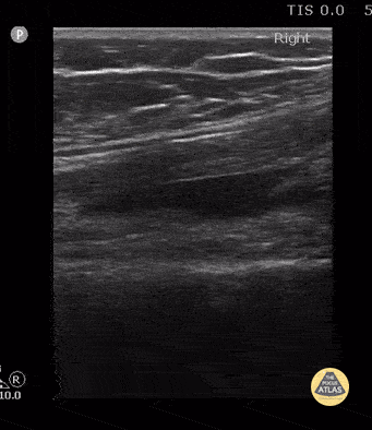 Peds-MSK - Knee Effusion