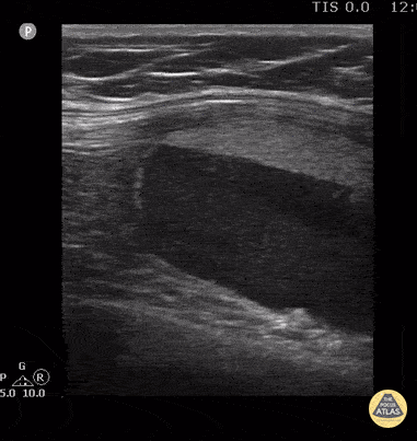 Peds-MSK - Knee Lipohemarthrosis-Case Series (1/3)