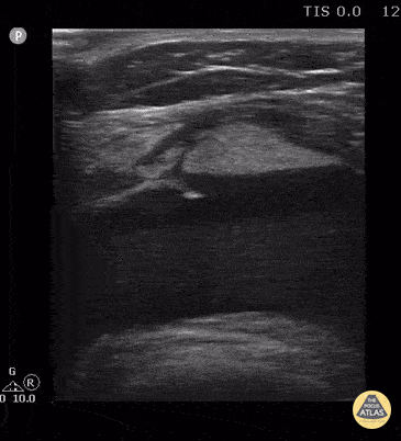 Peds-MSK - Knee Lipohemarthrosis-Case Series (2/3)