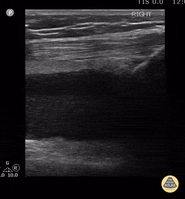 Peds-MSK - Knee Lipohemarthrosis-Case Series (3/3)